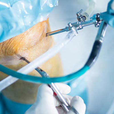 arthroscopy in Vijayawada